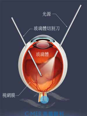 孔源性视网膜脱离的4种鉴别