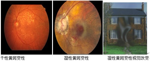 老年性黄斑变性 拖得越久越危险