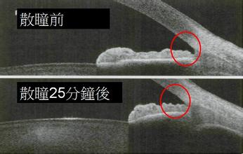 宅在家里“煲剧”，真能引发急性青光眼？