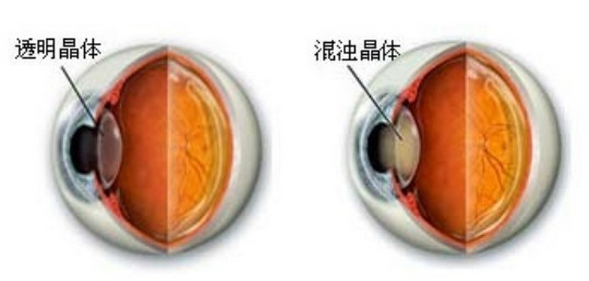 白内障与晶状体的关系