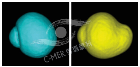 视轴与高度近视的关系