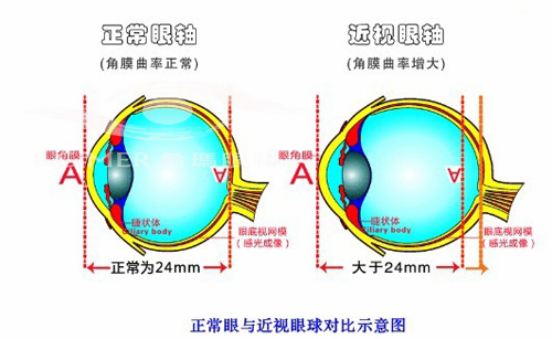 视轴与高度近视的关系