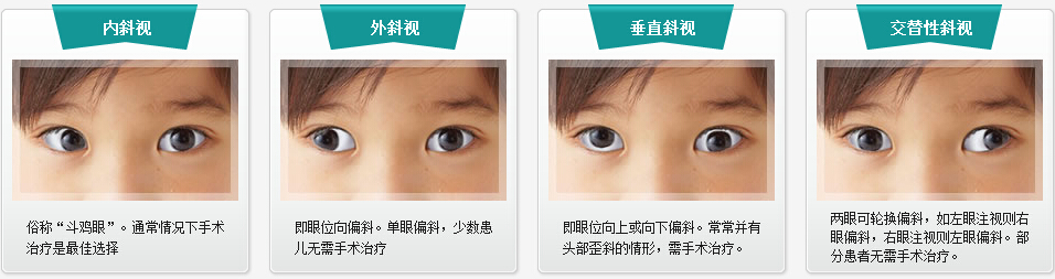 斜视：眼外肌决定眼位情况