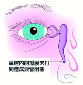 新生儿“眼脏”，不少家长误认为上火引起