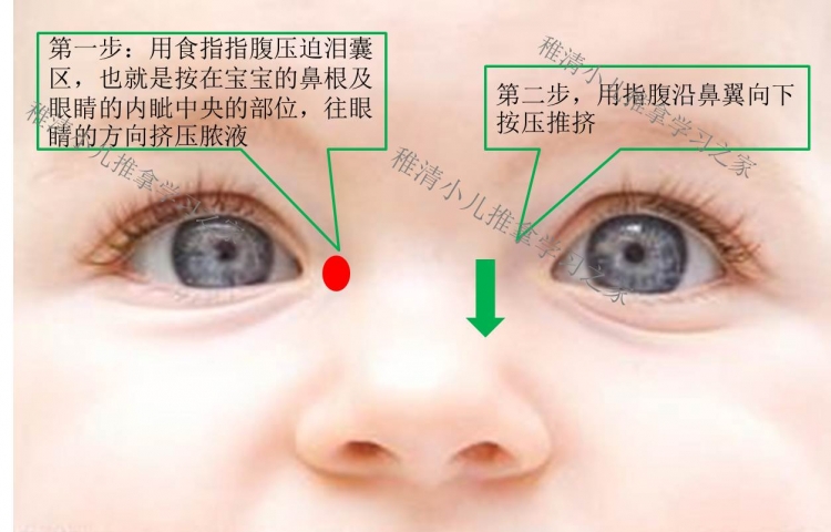 新生儿“眼脏”，不少家长误认为上火引起