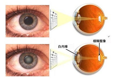 老人眼睛突然看清了，是返老还童？