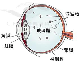 成年人治疗近视，角膜较薄怎么办?