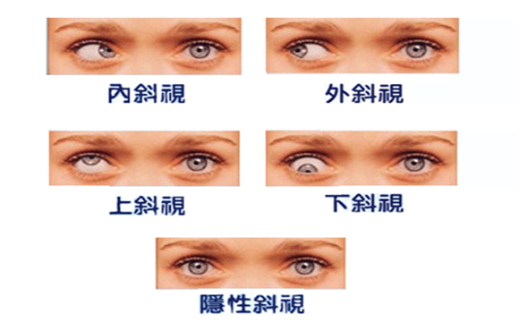 什么是斜视?斜视能治好吗?