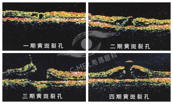 黄斑裂孔4期