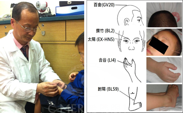 针灸治疗