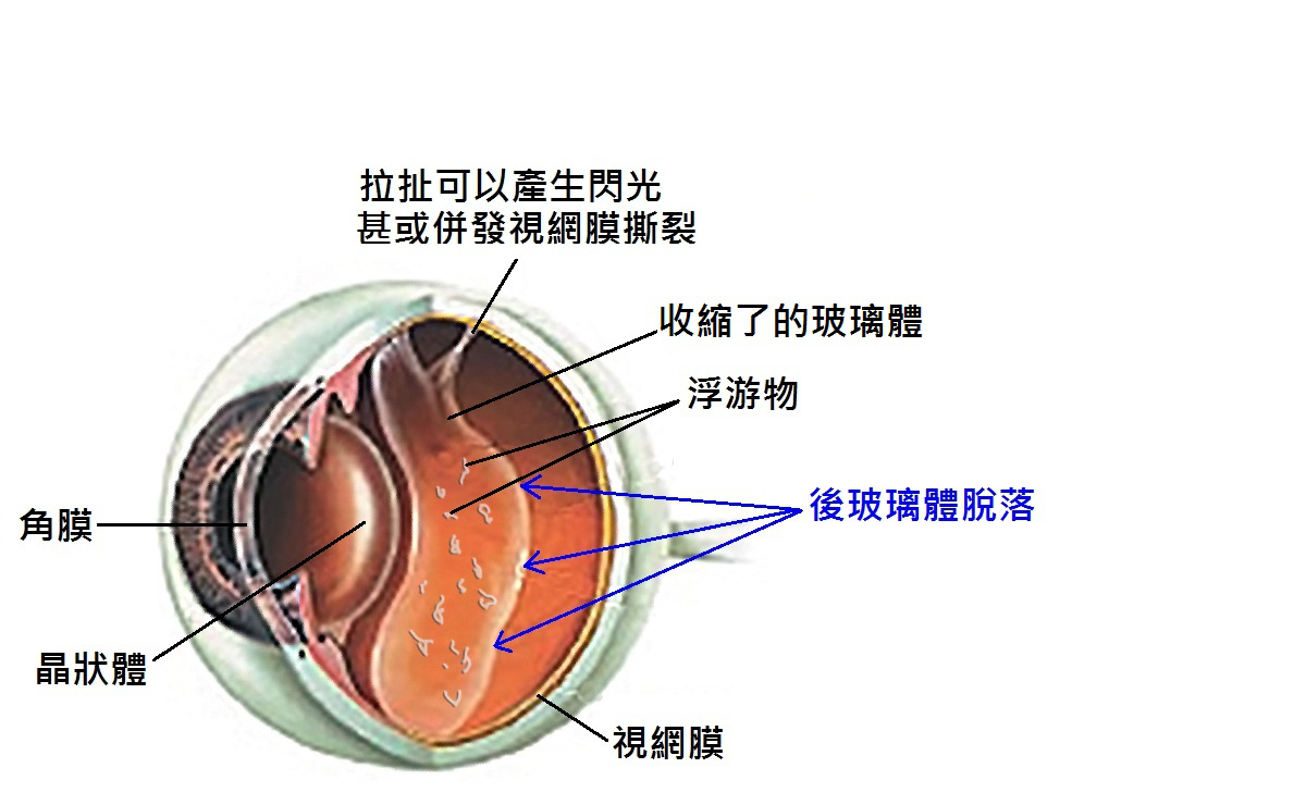 (后玻璃体脱落)
