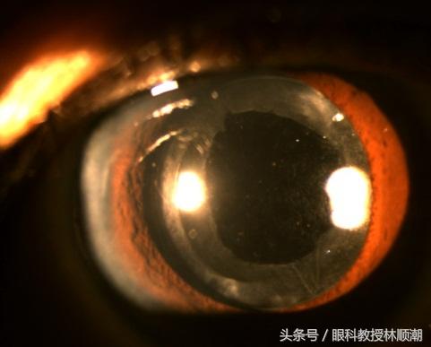 白内障手术后“复发”不用担心