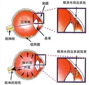 青光眼症状
