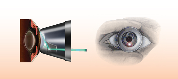 青光眼治疗 青光眼治疗