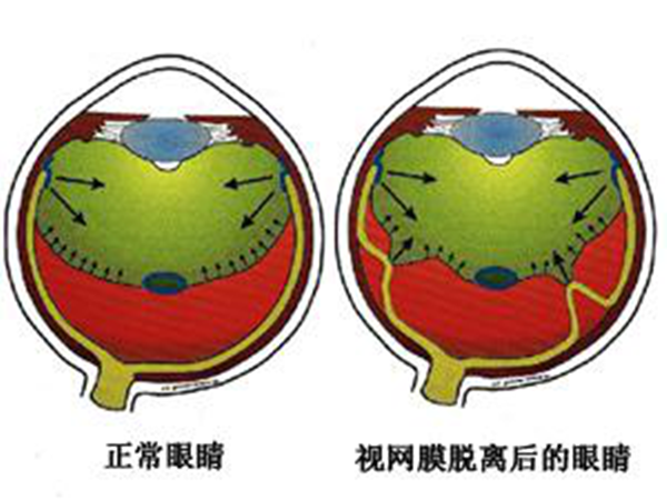 眼病科普
