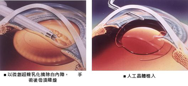 眼病科普