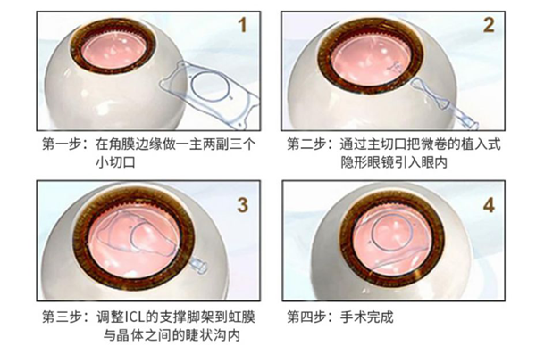 高度近视