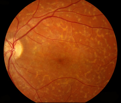 黄斑变性眼健康的"无形杀手" oct无创成眼底检查主流_深圳希玛林顺潮