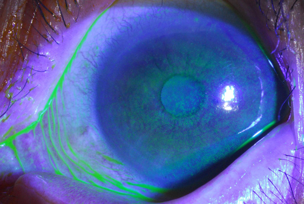 (角膜荧光染色法)确定好干眼症的原因与严重程度后,可根据医生建议